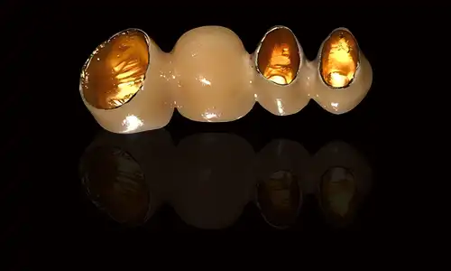 When Should Dentists Choose PFM Yellow Gold Crowns for Posterior Teeth?